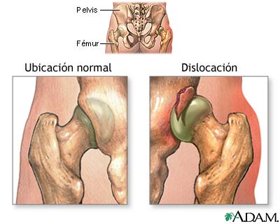 Dislocación de la cadera