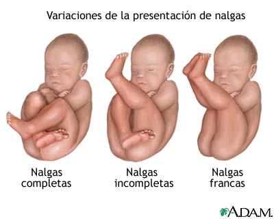 Tipos de presentaci&oacute;n de nalgas