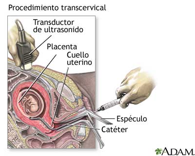 Procedimiento (segunda parte, transcervical)