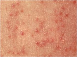 Primer plano de la queratosis pilaris
