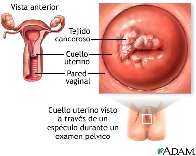 C&aacute;ncer cervical