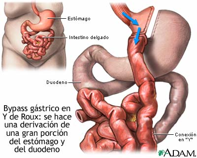 Cirugía gástrica en Y de Roux para perder peso