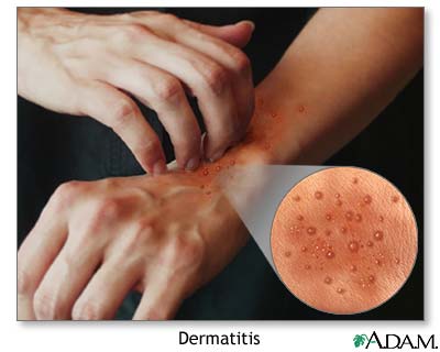 Dermatitis atópica