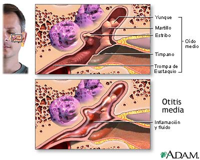 Infección del oído medio (otitis media)