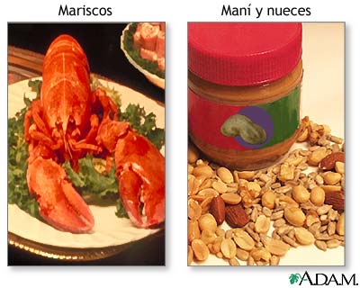 Alergias alimentarias