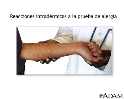 Reacciones intradérmicas a la prueba de alergia