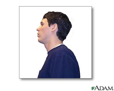 Uso del inhalador de dosis medidas (Tercera parte)