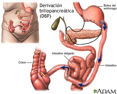 Derivaci&oacute;n biliopancre&aacute;tica (BPD)