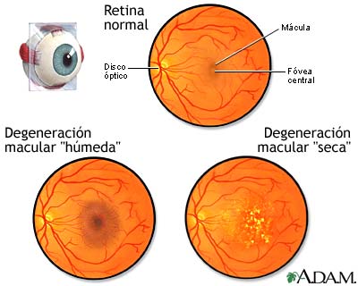 Degeneraci&#243;n macular