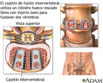 Cajet&iacute;n de fusi&oacute;n intervertebral