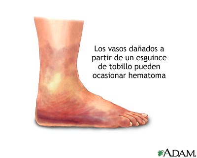 Inflamación por esguince de tobillo