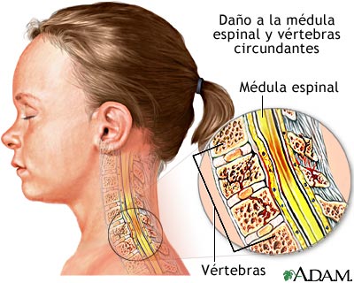 Lesión a la médula espinal