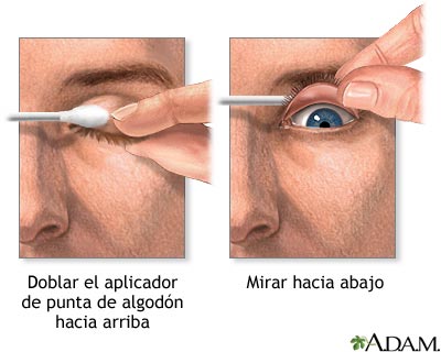 Eversión del párpado