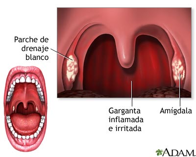 Faringitis estreptocócica