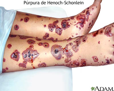 P&uacute;rpura de Henoch-Schonlein