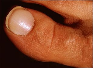 S&iacute;ndrome de la u&ntilde;a blanca