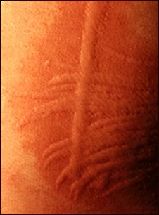 Dermatografismo - de cerca