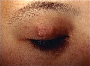 Granuloma anular en el párpado