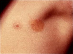Urticaria pigmentosa en la axila