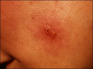 Leishmaniasis mexicana, lesi&oacute;n en la mejilla