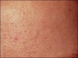 Primer plano de las espinillas (comedones)