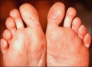 Enfermedad de boca-mano-pie en la planta de los pies