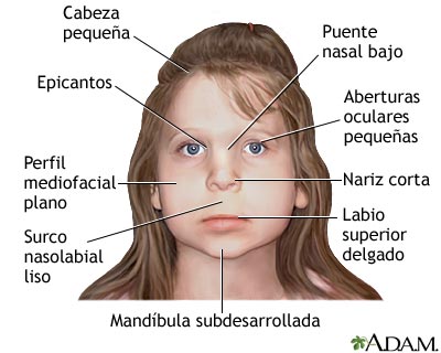Síndrome de alcoholismo fetal