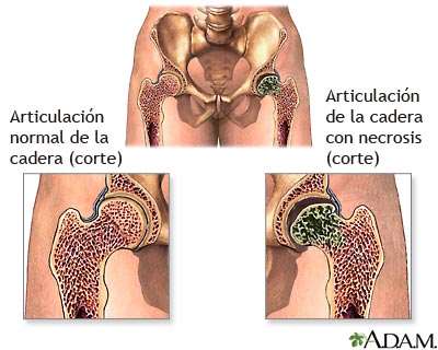 Necrosis aséptica