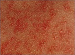 Primer plano de eritema t&oacute;xico del reci&eacute;n nacido