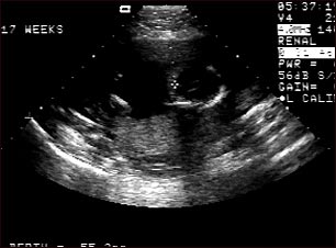 Ultrasonido de un feto normal; ventrículos cerebrales