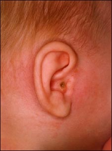 Mastoiditis - vista lateral de la cabeza