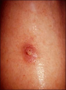 Queratoacantoma