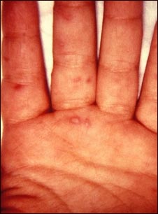 Enfermedad boca-mano-pie en la mano