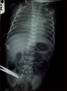 Retorno venoso pulmonar total anómalo, rayos X