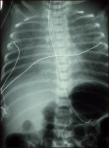 Retorno venoso pulmonar total anómalo, rayos X