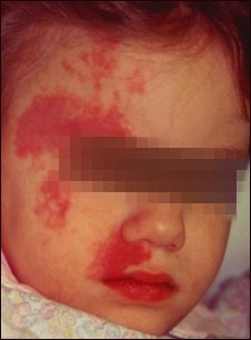 Mancha en vino de Oporto en la cara de un niño