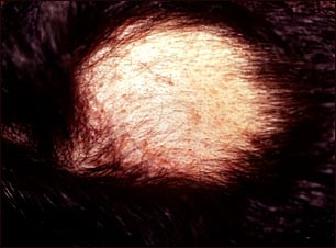 Alopecia areata con p&uacute;stulas