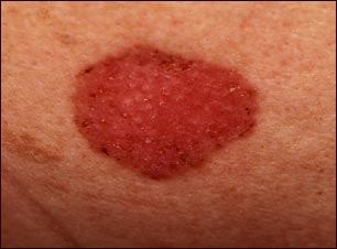 Cáncer de piel o carcinoma de célula basal en propagación