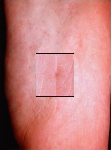Síndrome de nevo de célula basal en depresión plantar