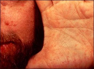 S&#237;ndrome de nevo de c&#233;lula basal en cara y mano
