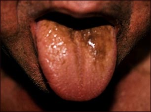 Lengua negra peluda