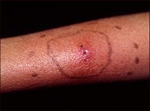 Celulitis