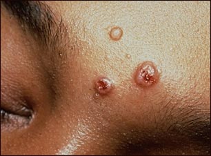 Criptococosis en la frente