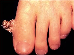 Verruga con un cuerno cut&aacute;neo en el dedo del pie