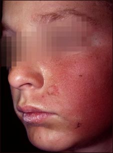 Dermatitis de contacto en la mejilla