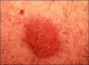 Dermatitis por contacto, pustular