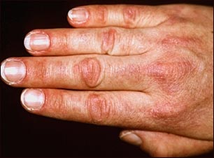 Pápula de Gottron en dermatomiositis