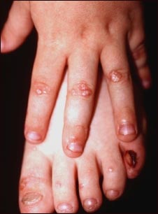 Epidermólisis bullosa distrófica dominante