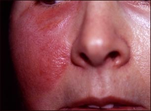 Erisipela en las mejillas