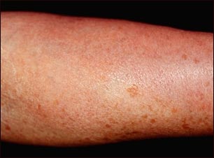Mastocitosis cutánea difusa